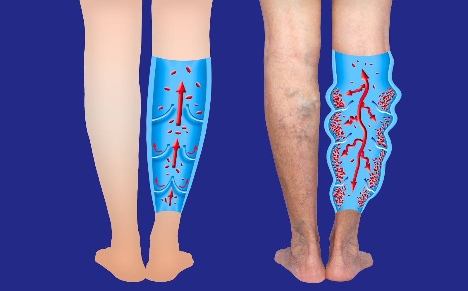https://www.medtronic.com/us-en/patients/treatments-therapies/varicose-vein-treatments/venaseal-procedure.html
